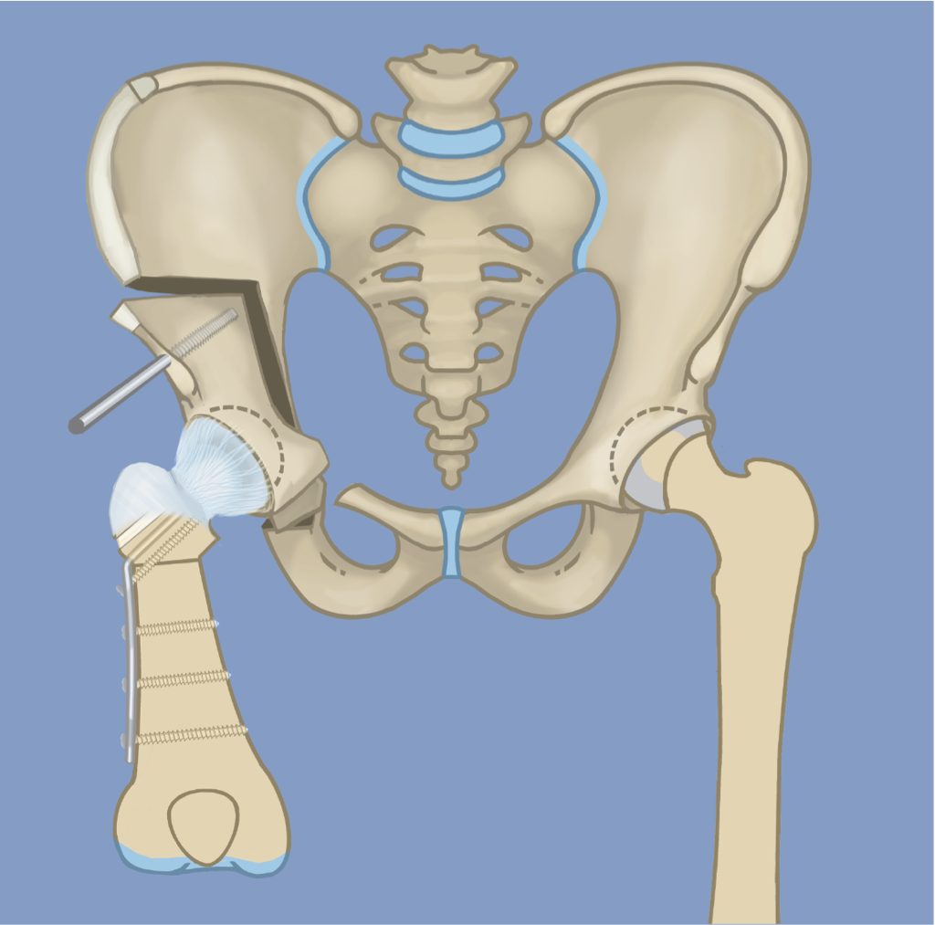  Hip Osteotomy